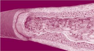 Visual of remnant dyslipidemia showing the inside of an artery filled with plaque